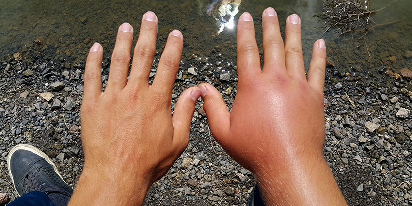 patient needing complex regional pain syndrome relief in Irvine