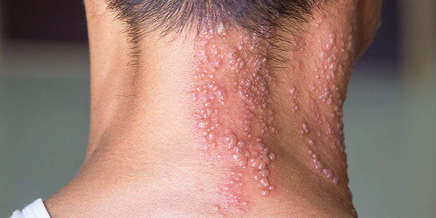 patient needing post herpetic neuralgia relief in Irvine