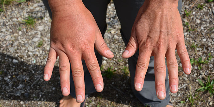 reflex sympathetic dystrophy treatment and chiropractic conditions in Irvine