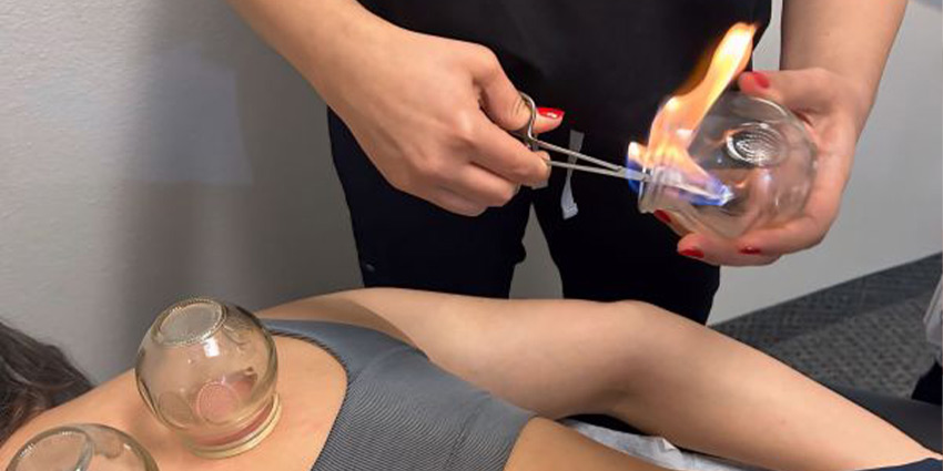 patient receiving cupping therapy in Irvine