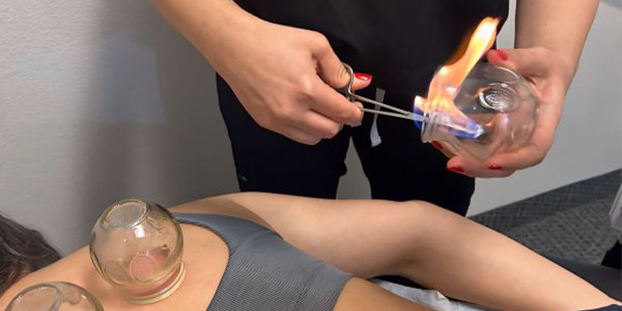cupping therapy in Irvine, CA