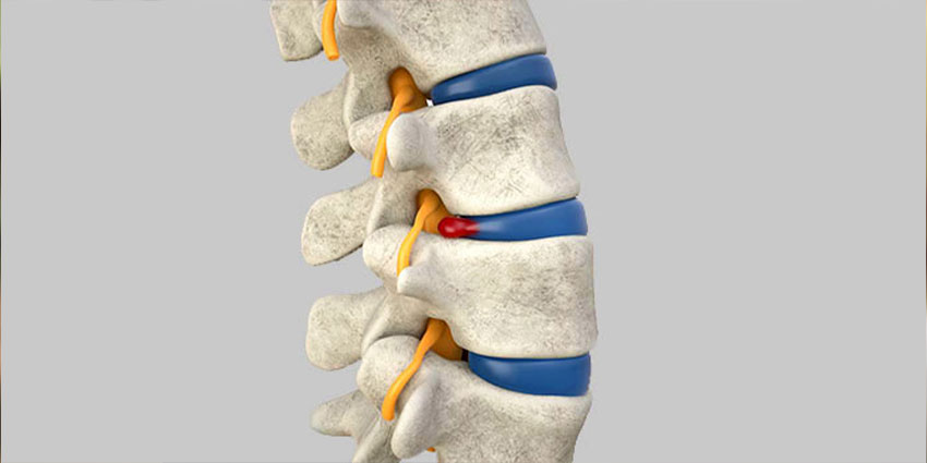 patient needing herniated disc chiropractor in Irvine