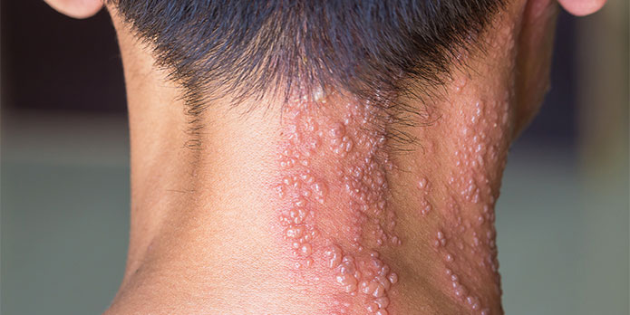 post-herpetic neuralgia treatment and chiropractic conditions in Irvine