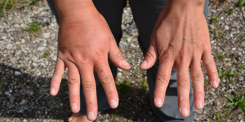 patient needing reflex sympathetic dystrophy relief in Irvine